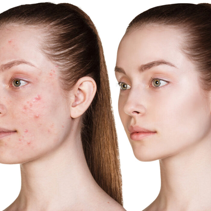 Laser Acne