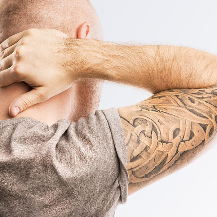 Laser Tatoo Removal